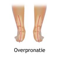 Isaac katoen bibliotheek Overpronatie: alles over de oorzaken en juiste behandeling